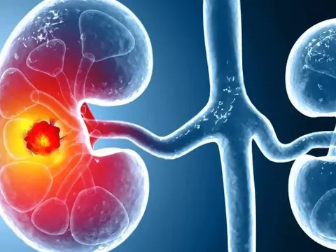 Số ca mắc ung thư thận gia tăng trên toàn cầu: Ở giai đoạn sớm hay muộn đều có 3 dấu hiệu này