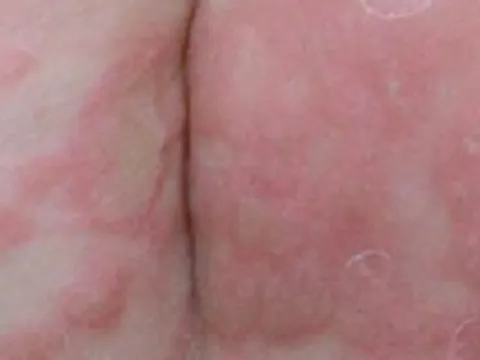 Bé trai 3 tuổi bị giang mai bẩm sinh dù không có triệu chứng