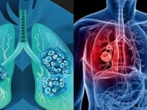 WHO khuyến cáo chỉ cần thay đổi một điều này, nguy cơ UNG THƯ có thể giảm mạnh: Gần 40% ca bệnh hoàn toàn có thể phòng tránh