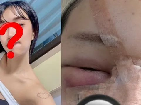 Trùng tu nhan sắc để ăn Tết, 1 sao nữ mặt mũi biến dạng, sưng phồng như bị "500 con ong đốt"