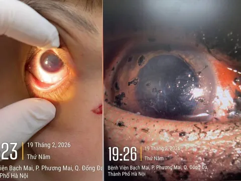 Bệnh viện Bạch Mai cảnh báo 1 tình trạng bệnh ở mắt tăng vọt ngay trong 3 ngày đầu năm 2026