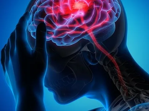 Đột quỵ gia tăng: Nghiên cứu Mỹ hé lộ thủ phạm mới