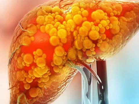 Bác sĩ nói thẳng: Thói quen này âm thầm gây gan nhiễm mỡ nhưng toàn bị xem nhẹ