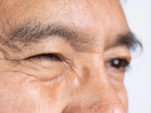 Mắt phải giật là điềm xấu, mắt trái giật là điềm may? Bác sĩ nhãn khoa tiết lộ sự thật