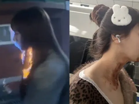 Nữ diễn viên bị bỏng nặng gương mặt ngay trong ngày sinh nhật tuổi 27 vì đu trend "bánh kem phun lửa"