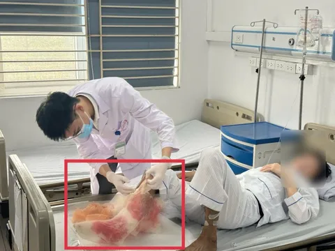 Suýt mất chân vì đắp lá chữa bỏng lửa suốt 1 tháng