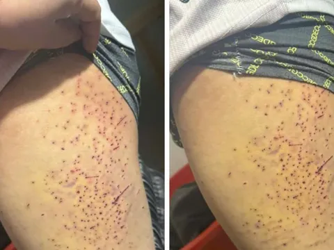 Xác minh thông tin học sinh nghi bị bạn dùng vật nhọn gây thương tích