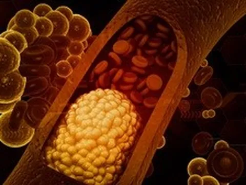 Ăn nhiều rau luộc, ít thịt cả 3 bữa trong ngày nhưng mỡ máu vẫn cao vút: Bất ngờ với "thủ phạm"