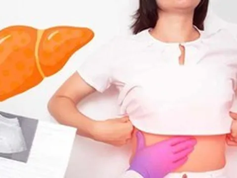 Với gan nhiễm mỡ, ngoài “ngậm miệng và đá chân", còn có 1 việc bắt buộc phải làm mà nhiều người không biết