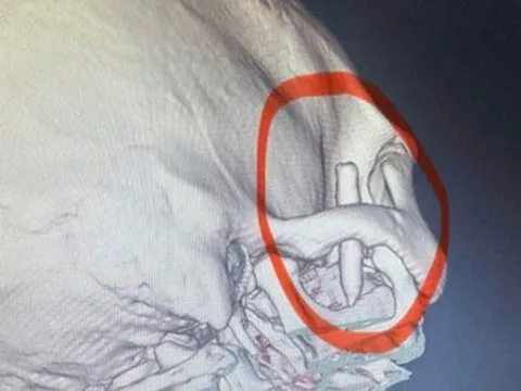 Chàng trai đau thái dương suốt 13 năm, bác sĩ phát hiện ra bí mật "đáng sợ" bên trong