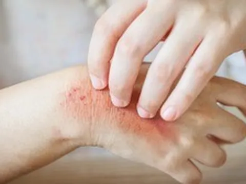 Muốn biết thận khỏe hay không, cứ nhìn vào da sẽ rõ: Đây là 7 dấu hiệu nếu có cần đi khám ngay