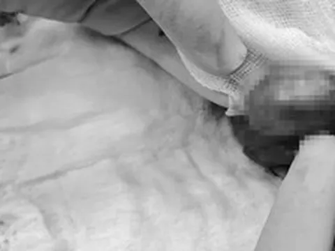 Nửa đêm đau âm ỉ vùng kín, nam sinh suýt mất tinh hoàn vì chủ quan