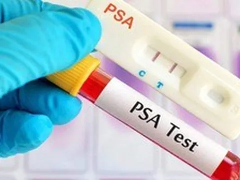 3 ca ung thư tuyến tiền liệt trong 1 ngày, bác sĩ chỉ lý do bệnh dễ bị bỏ sót