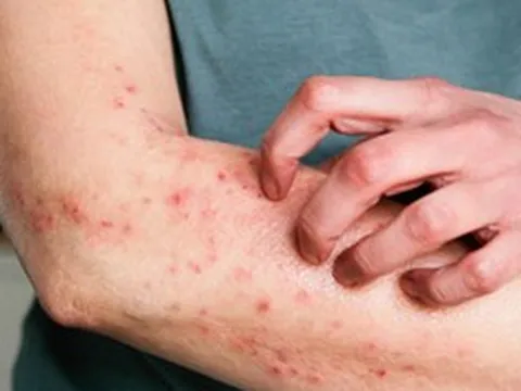 Bộ Y tế yêu cầu không để dịch bệnh viêm màng não mô cầu lan rộng tại cộng đồng