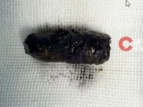 Mũi người đàn ông chảy dịch dai dẳng, bác sĩ phát hiện bí mật đáng sợ