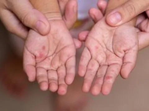 Ba tháng đầu năm ghi nhận gần 25.000 ca tay chân miệng, Bộ Y tế chỉ đạo khẩn