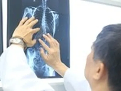 Nhiều trẻ vẹo cột sống nặng mới đi khám, chuyên gia cảnh báo nguy cơ biến chứng nặng