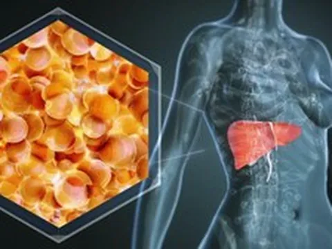 1 bệnh về gan “bùng lên”, người trẻ cũng không còn an toàn: Bác sĩ chỉ ra xu hướng điều trị mới