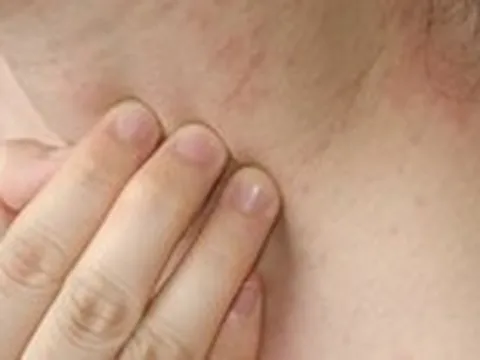 Ngứa kéo dài có thể là dấu hiệu cảnh báo sớm suy thận