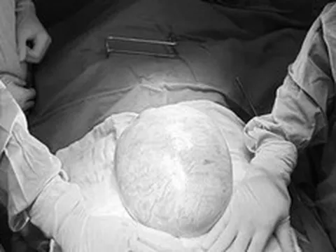 Bé gái 13 tuổi bụng to bất thường, bố mẹ sốc khi phát hiện bí mật "đáng sợ" bên trong