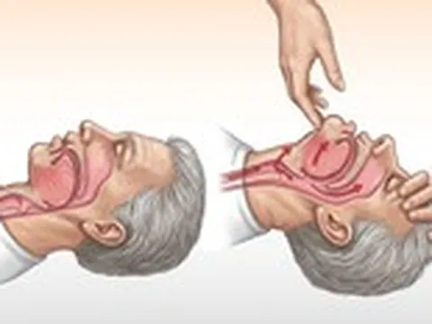 Đừng kéo lưỡi khi cấp cứu 'nuốt lưỡi'
