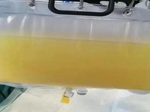 Rút ra 2 lít máu trắng đục như sữa từ cô bé 12 tuổi, bố mẹ oà khóc: "Tưởng cháu đau bụng vì ăn đồ không sạch"