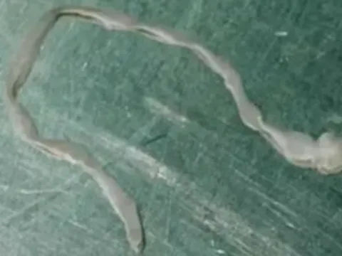 Người phụ nữ lên cơn co giật, bác sĩ lấy ra thứ đáng sợ trong não