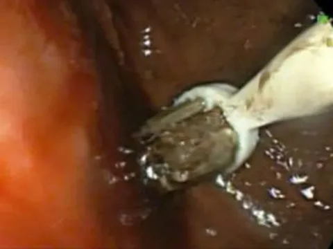 Nam thanh niên 29 tuổi đau bụng, bác sĩ lấy ra thứ "đáng sợ" trong cơ thể