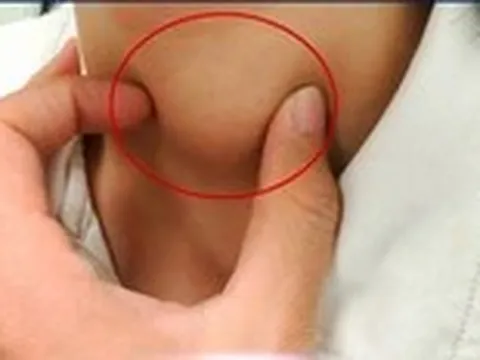 Viêm tuyến giáp có làm tăng nguy cơ ung thư?