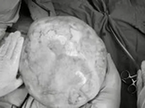 Hy hữu bé gái 14 tuổi mang khối u nặng hơn 4kg có răng, tóc, xương