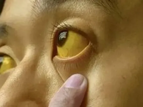 Nếu mắt có 6 thứ, đi khám ung thư ngay còn kịp!