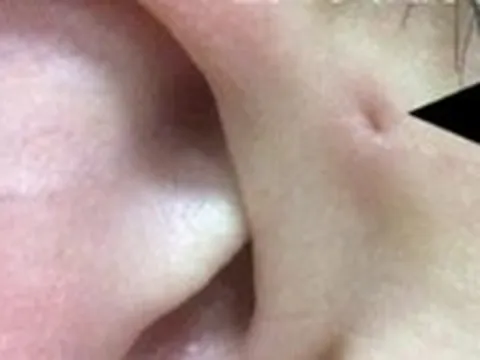 Gia đình 3 thế hệ cùng mắc bệnh ít gặp rò luân nhĩ: Bệnh có nguy hiểm không?