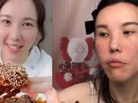 Mặt cô gái trẻ biến dạng sau 2 năm làm mukbang, bác sĩ cảnh báo 4 cái giá phải trả về sức khỏe ít ai biết đến