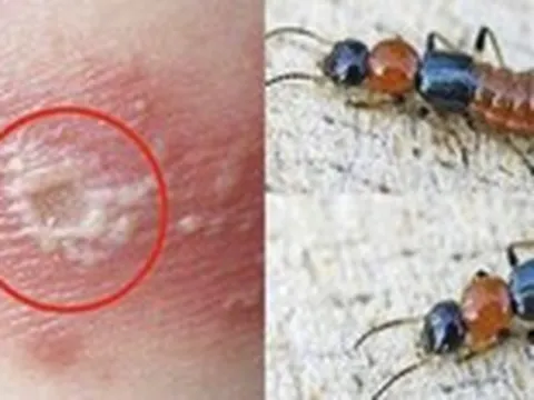 Mùa kiến ba khoang, cẩn trọng nhầm với zona thần kinh