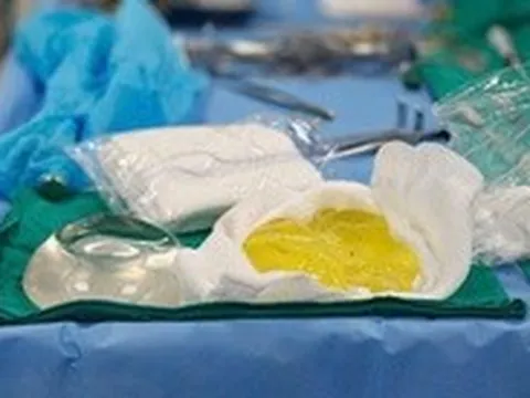 Phát hiện túi ngực vỡ vụn sau 5 năm: Bác sĩ cảnh báo biến chứng âm thầm dễ bỏ qua
