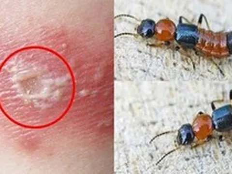 5 bước xử lý đúng cách khi tiếp xúc với kiến 3 khoang