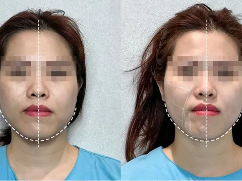 Chỉnh lệch mặt không phẫu thuật và giải pháp an toàn tại iBONE FiSiO